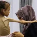 Seorang anak perempuan di Gaza yang mengalami malnutrisi akut. (©WHO)