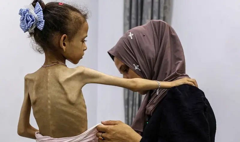 Seorang anak perempuan di Gaza yang mengalami malnutrisi akut. (©WHO)